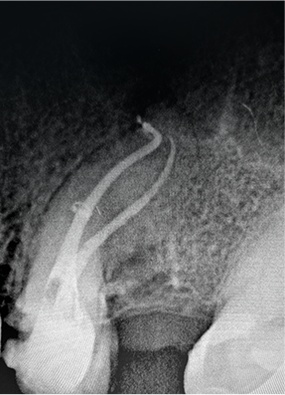 Post-operative obturation