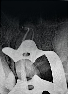 Pre-operative X-ray