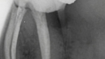 Centered in Complexity: Chameleon Dual Shaper in a Hot, Calcified Molar