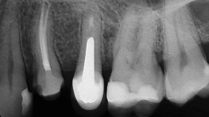 Minimal Taper, Maximum Control: Chameleon Dual Shaper in Maxillary Premolar