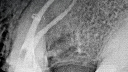 Double Curve, Single Choice: Kite Gold in Maxillary Premolar